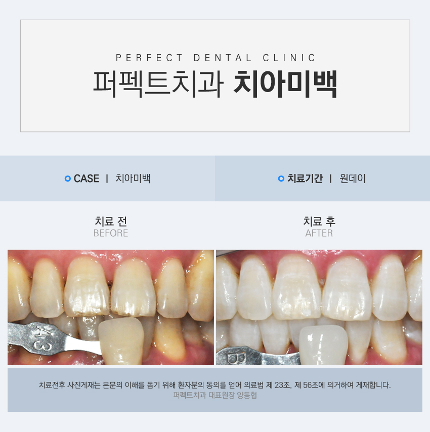 누런이 스트레스는 치아미백으로! 관련 이미지 3