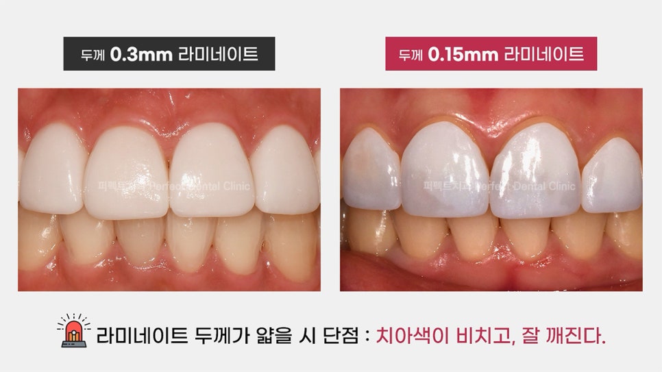 라미네이트 얇을수록 좋은가요? 관련 이미지 4