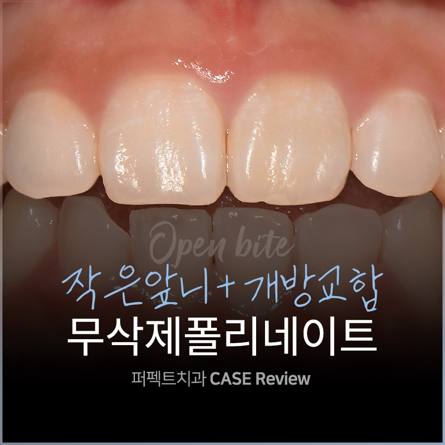 왜소치와 개방교합 문제를 한 번에 개선하다. 관련 이미지 1