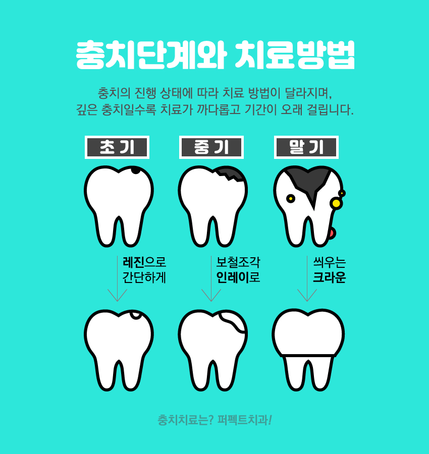 세라믹 인레이 충치치료 비용 관련 이미지 6