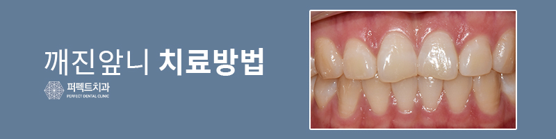 깨진 앞니라미네이트 비용 관련 이미지 6