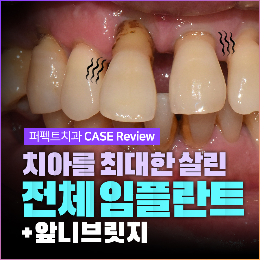 흔들리는 치아, 전체임플란트+앞니브릿지로 살리다. 관련 이미지 1