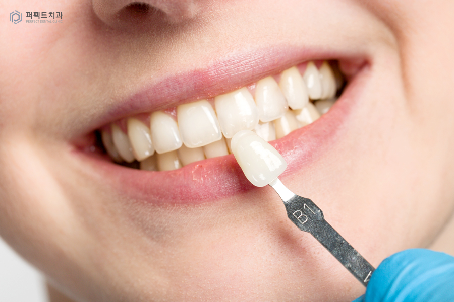 라미네이트를 해야한다면? 색상, 모양을 결정하는 tip! 관련 이미지 5