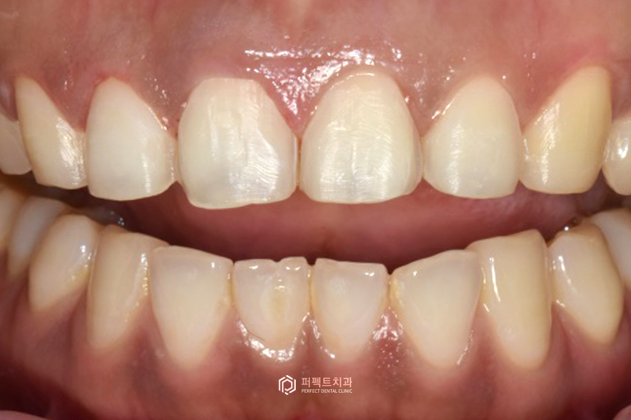 나비치아, 부분교정vs라미네이트 치과의사가 추천하는 방법은? 관련 이미지 8