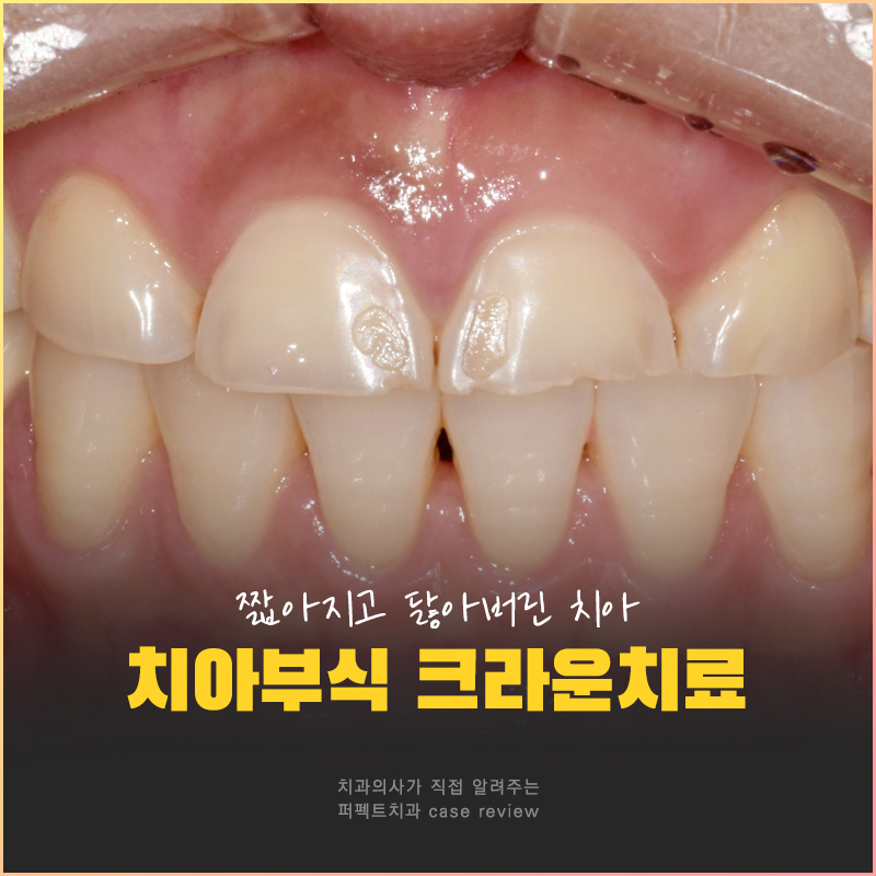 치아부식으로 크라운까지 하게 된 이유는? 관련 이미지 1