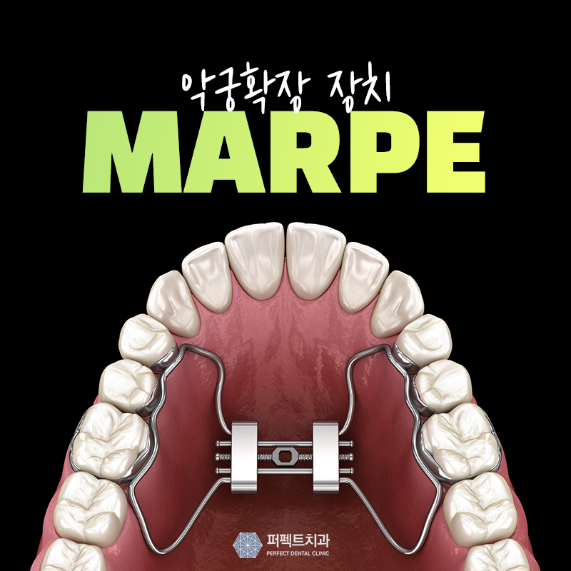 marpe 악궁확장치로 비발치교정 관련 이미지 1