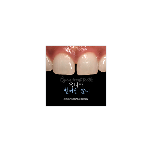 옥니, 벌어진 앞니 치료 결과는? 관련 이미지 3