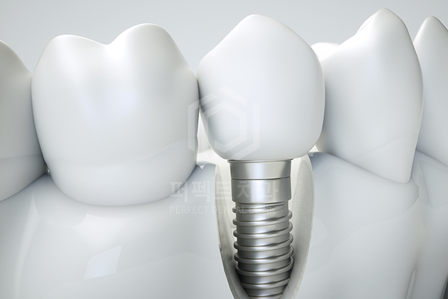 임플란트도 부작용이 있다?① 관련 이미지 1