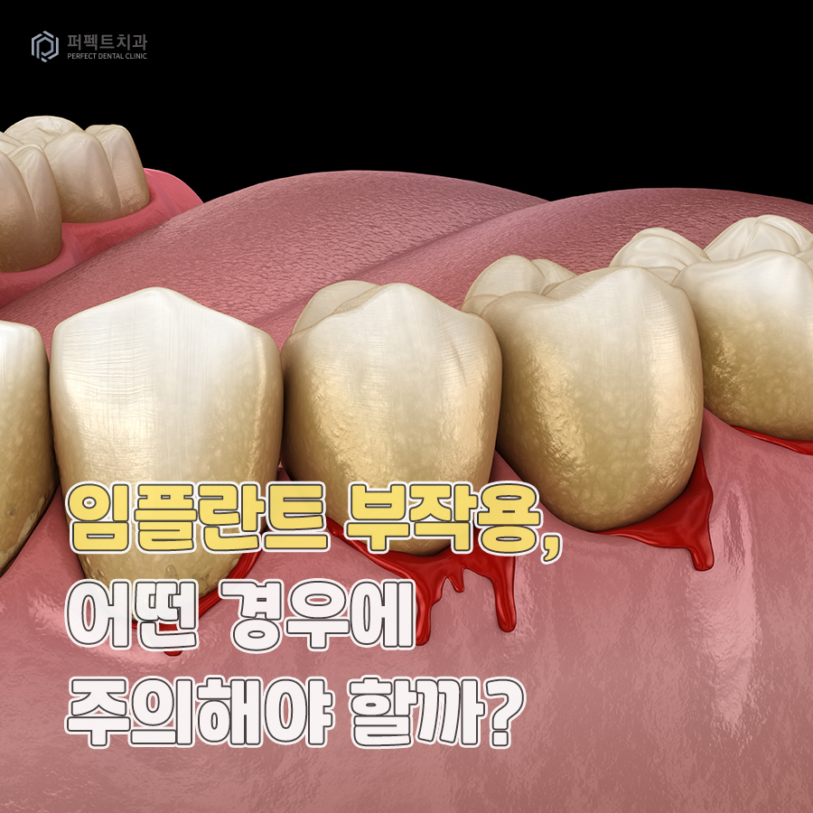 임플란트 부작용, 어떤 경우에 주의해야 할까? 관련 이미지 1