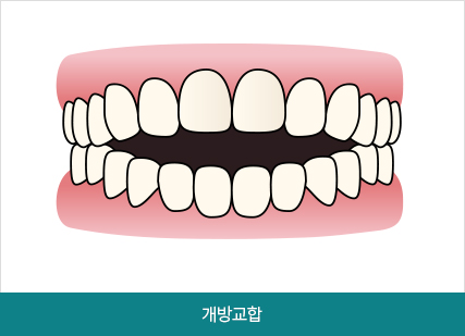 비발치로 덧니,개방교합 교정하기! 관련 이미지 3