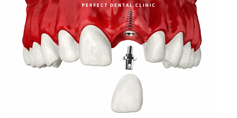 20대 임플란트 망설이지 마세요! 관련 이미지 2