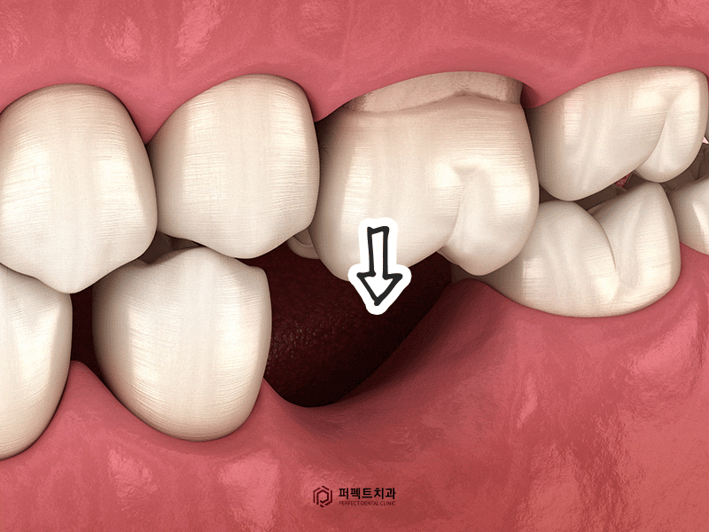 무절개 임플란트, 3분 안에 가능할까? 관련 이미지 3