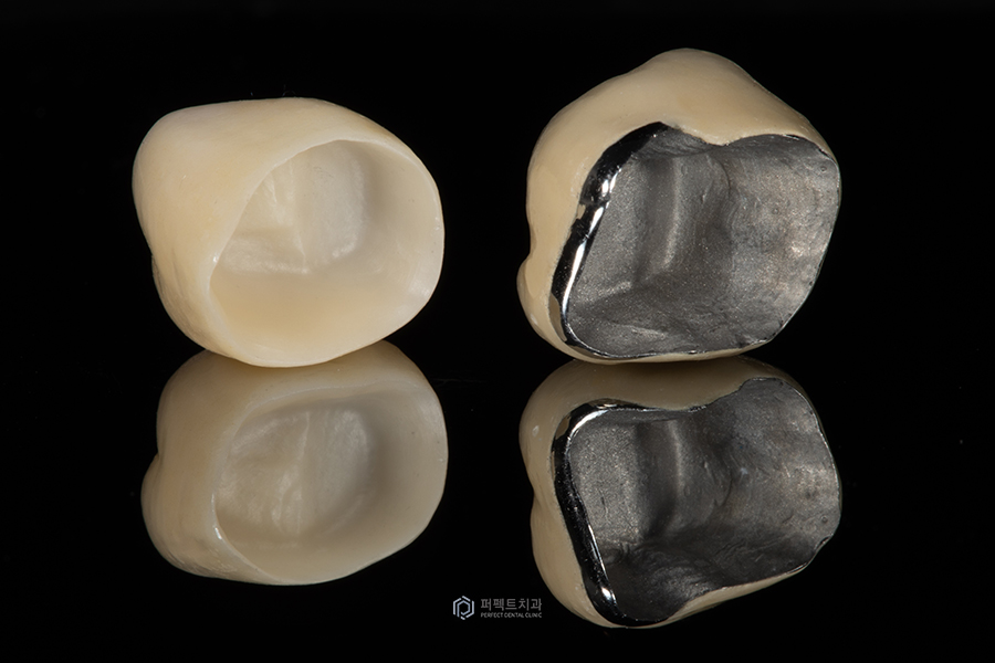 #3탄_의료보험 적용되는 치과치료는?(임플란트편) 관련 이미지 4
