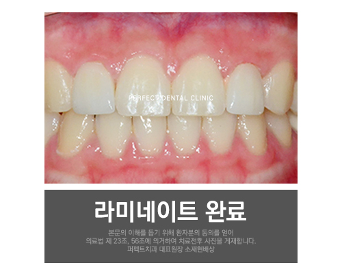 치아교정 후 치아모양이 마음에 들지않으면? 관련 이미지 4