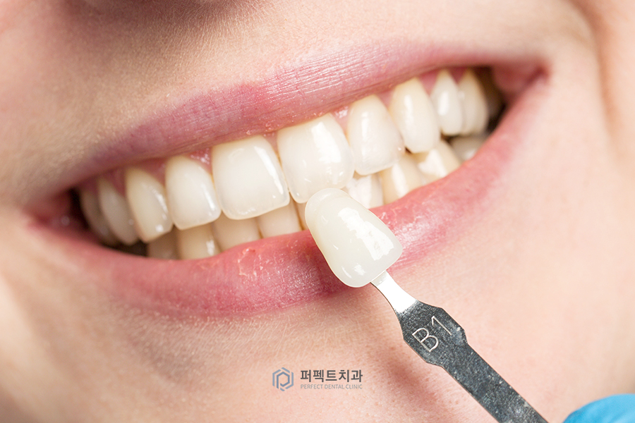 임시치아부터 라미네이트까지✨ 주의사항 알아보기 관련 이미지 1