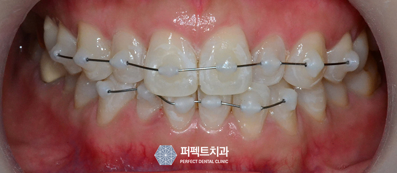 3개월 단기교정으로 빠르게! 관련 이미지 4