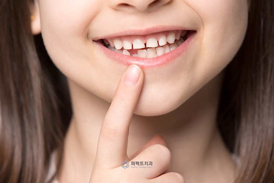 소아 치과치료①｜소아과잉치란? 관련 이미지 3