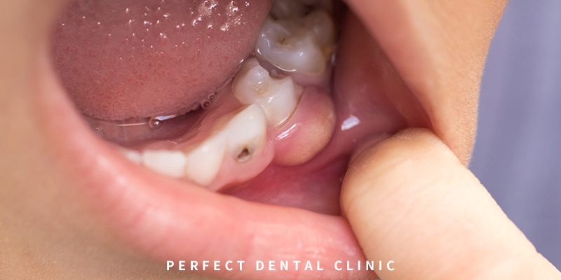 치아낭종 종류와 치료법 관련 이미지 1