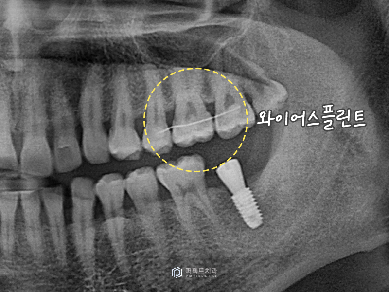 무절개 임플란트, 3분 안에 가능할까? 관련 이미지 4