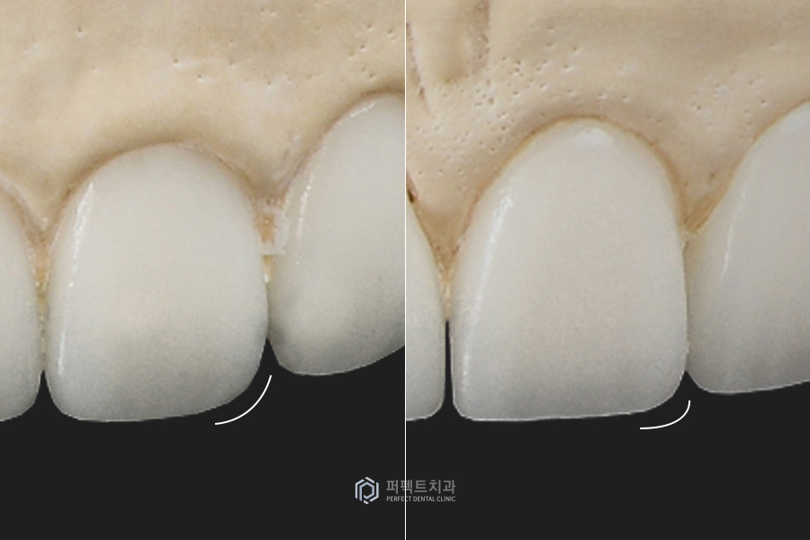 6년 전 라미네이트 교체&연장, 그 이유는?😯 관련 이미지 6
