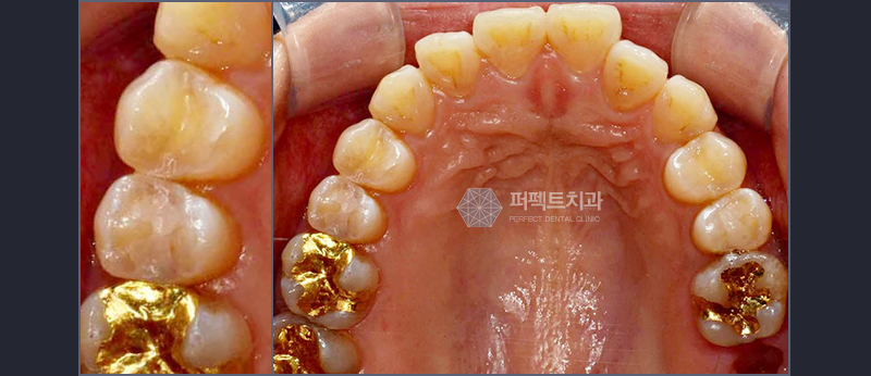 선릉 충치치료 인레이 알아보기! 관련 이미지 4
