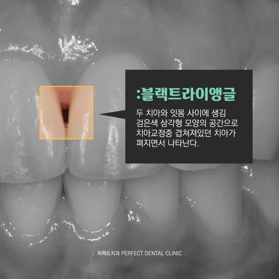 치아교정을 하면 꼭 블랙트라이앵글이 생기나요? 관련 이미지 2