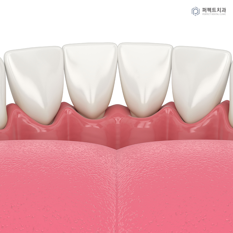 교정 후 잇몸퇴축은 흔하게 생기나요? 관련 이미지 3