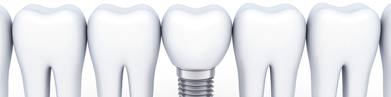 임플란트 충치 생길까? 관련 이미지 2