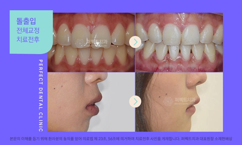덧니와 돌출입,  치아교정이 필요한 이유 관련 이미지 2