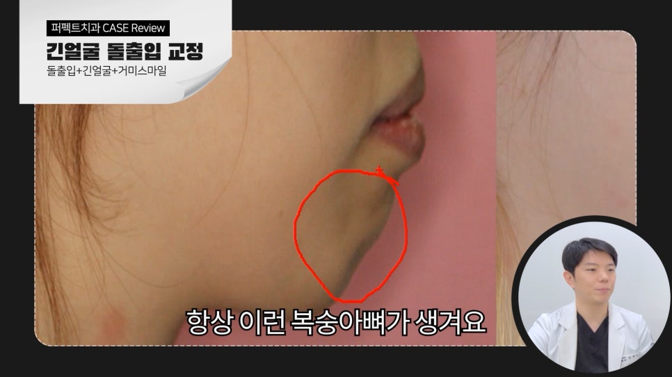 긴얼굴+돌출입+거미스마일 비수술교정case 관련 이미지 3
