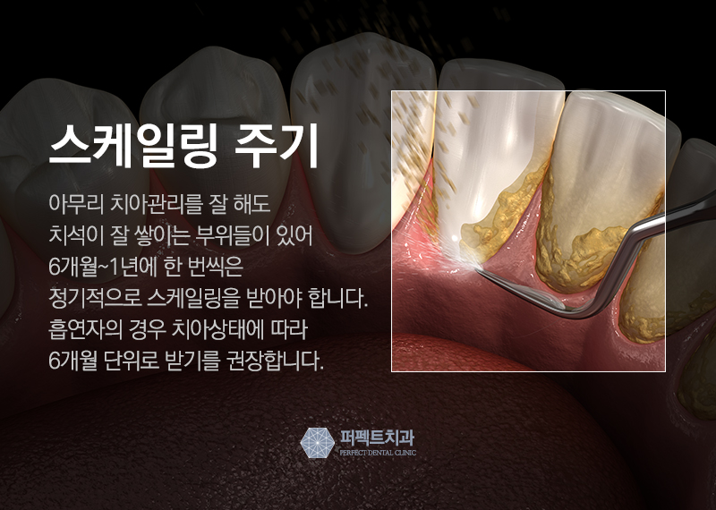 스케일링 의료보험 관련 이미지 3