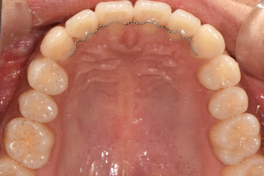 클리피씨를 이용한 부분교정, 얼마나 걸릴까? 관련 이미지 10