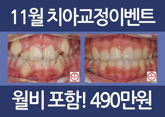 [교정치료]치아교정이벤트 관련 이미지 3