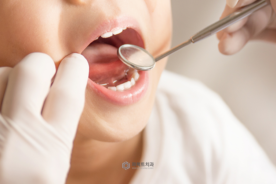 소아 치과치료①｜소아과잉치란? 관련 이미지 4