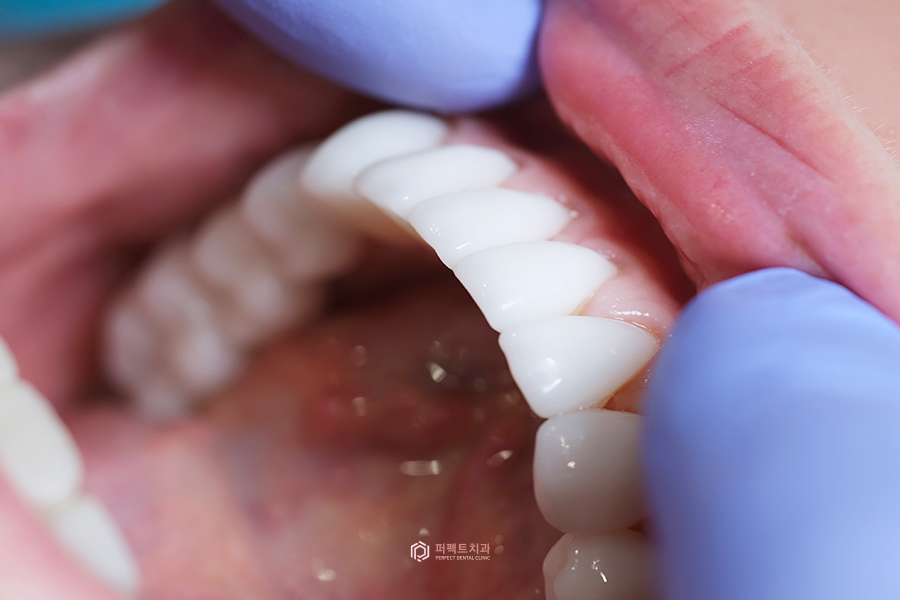 라미네이트로 치아교정 할 수 있나요? 관련 이미지 1