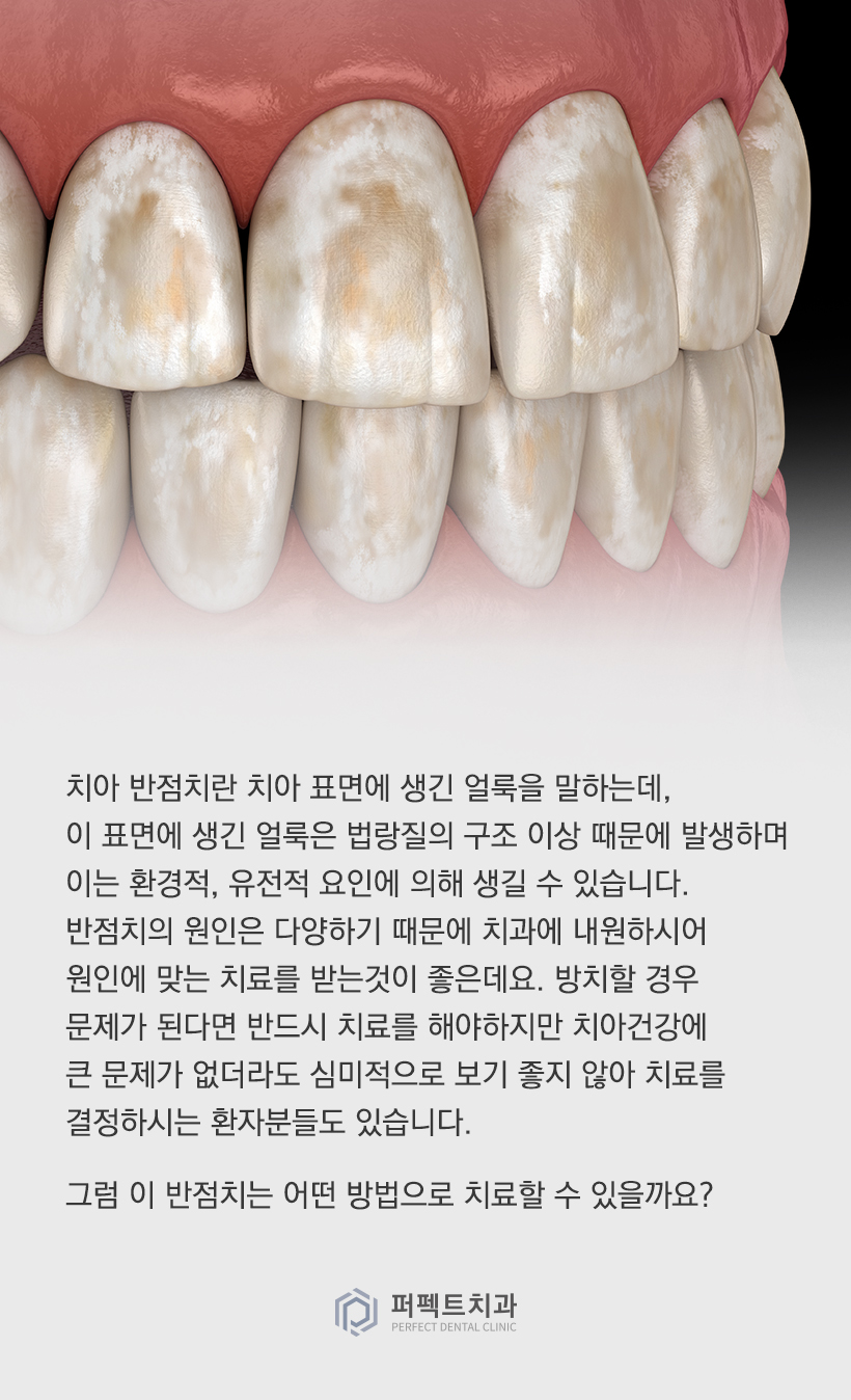 앞니 반점치는 어떻게 치료하나요? 관련 이미지 2