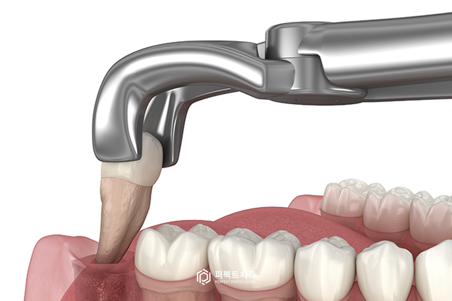 사랑니는 관련 이미지 1