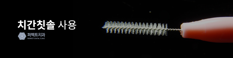 블랙트라이앵글, 치경부마모증 치과치료! 관련 이미지 3