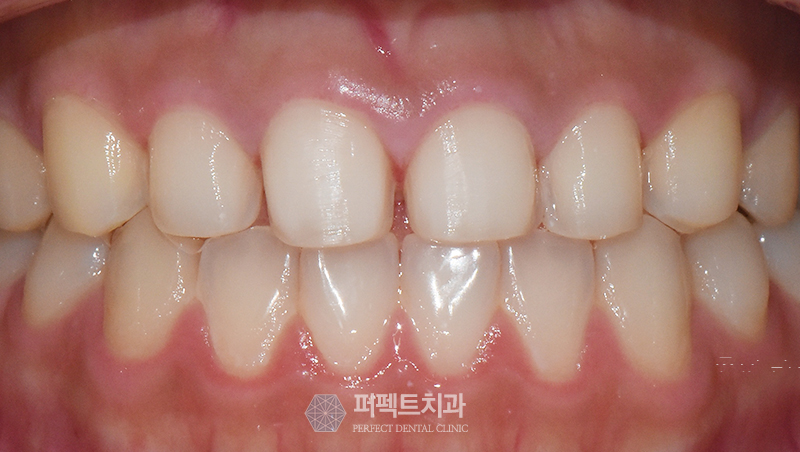 라미네이트 부작용 왜 나타나는 건가요? 관련 이미지 4