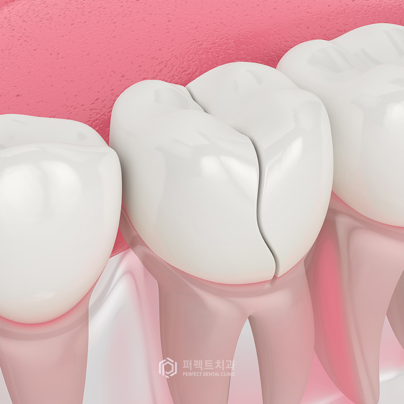 스케일링을 하면 치아가 깎이나요? 관련 이미지 3