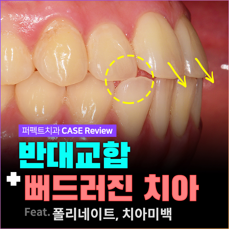 반대교합, 뻐드러진 치아 라미네이트 가능?! 관련 이미지 1