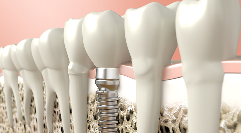 20대 임플란트 비용 걱정된다면? 관련 이미지 2
