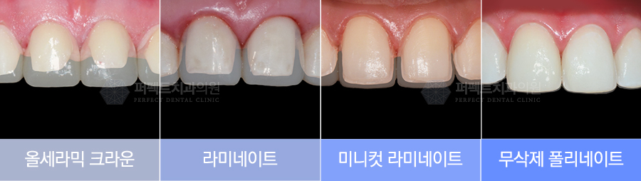 라미네이트 치료 시 참고사항은? 관련 이미지 3