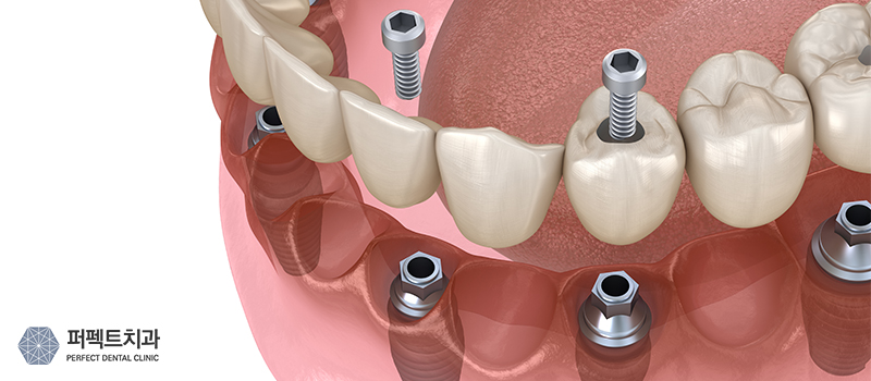 강남 임플란트 잘하는 곳 관련 이미지 2