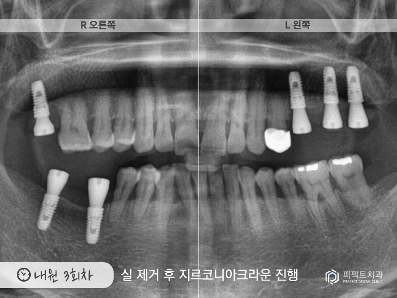 장거리+다수의 임플란트 케이스 관련 이미지 7