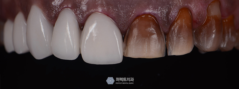 강남역치과, 앞니 라미네이트 가격 관련 이미지 2