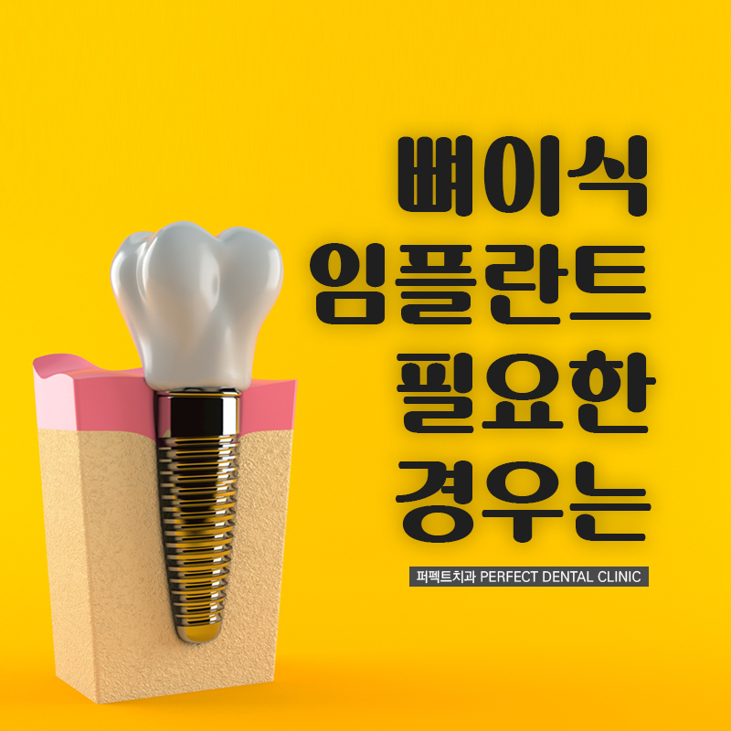 임플란트시 뼈이식이 필요한 경우 관련 이미지 1