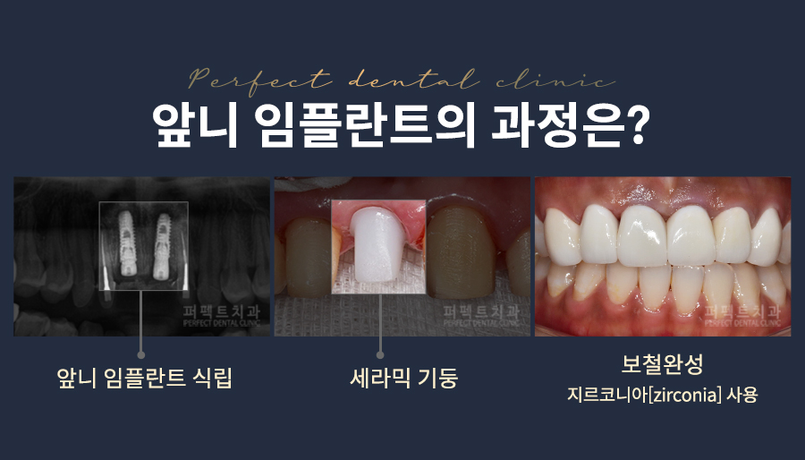 오스템임플란트 잘하는 선릉역 치과 관련 이미지 2