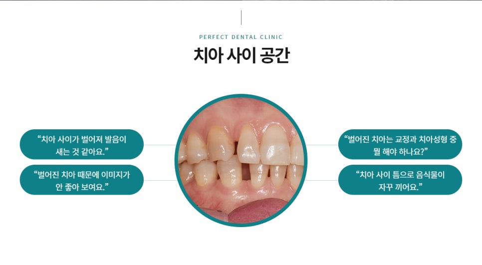 벌어진 치아, 무조건 교정을 해야한다? 관련 이미지 1