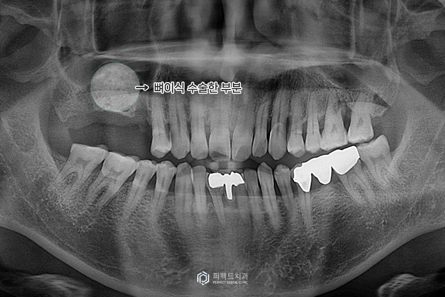 임플란트를 해야하는데 상악동에 염증이..😭 관련 이미지 6